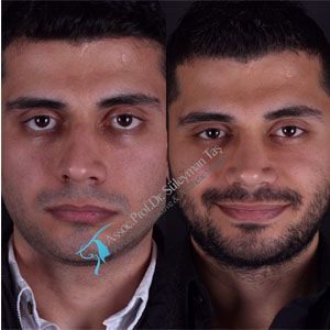 Male rhinoplasty vs. Female rhinoplasty