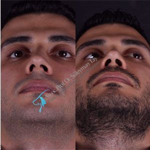 Male rhinoplasty vs. Female rhinoplasty