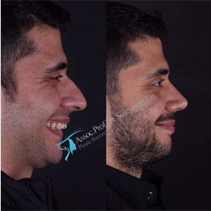 Male rhinoplasty vs. Female rhinoplasty