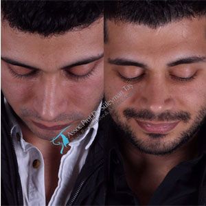 Male rhinoplasty before and after