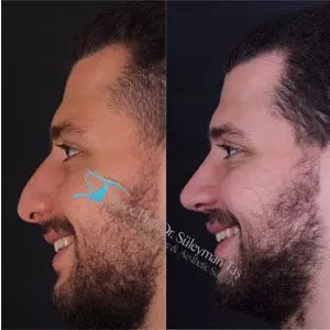 Male rhinoplasty before and after in turkey