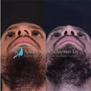Male rhinoplasty before and after in turkey
