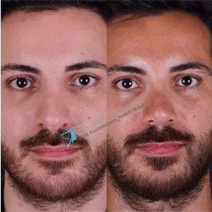Before and after rhinoplasty revision male in turkey