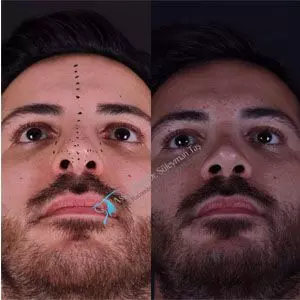 Before and after rhinoplasty revision male in turkey