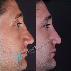 Rhinoplasty before and after revision male in turkey