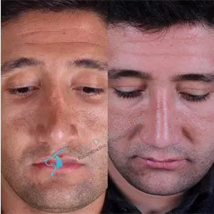 Rhinoplasty before and after revision male in turkey