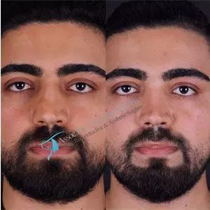 Rhinoplasty before and after gallery