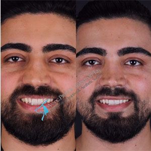 Aesthetic and functional rhinoplasty