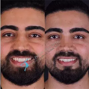 Revision male rhinoplasty before and after in turkey