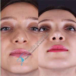 Aesthetic and functional rhinoplasty