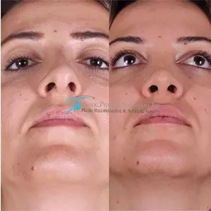 Is there scarring after a rhinoplasty (nose job)?