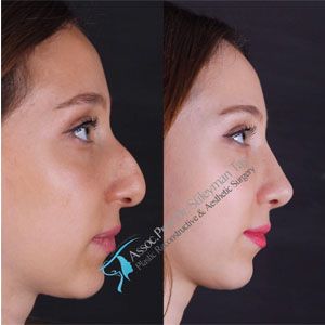 Aesthetic and functional rhinoplasty