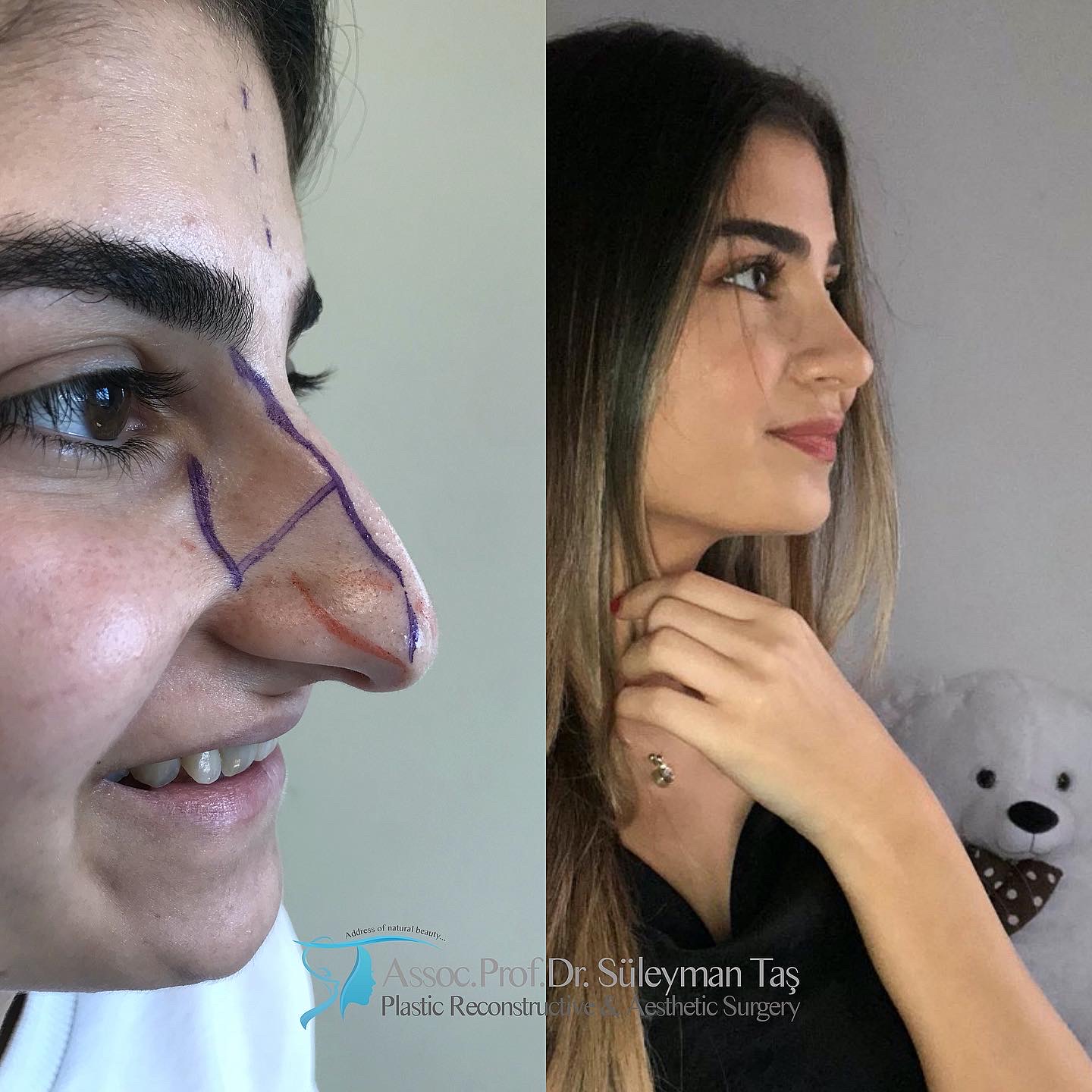 How much is the price of rhinoplasty?