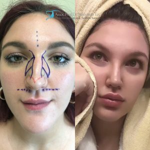 Celebrity nose job: before and after