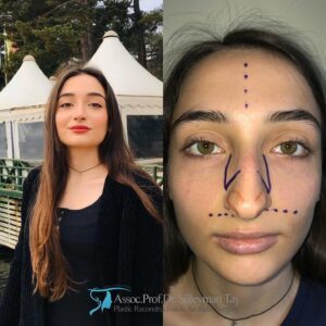 Celebrity nose job: before and after
