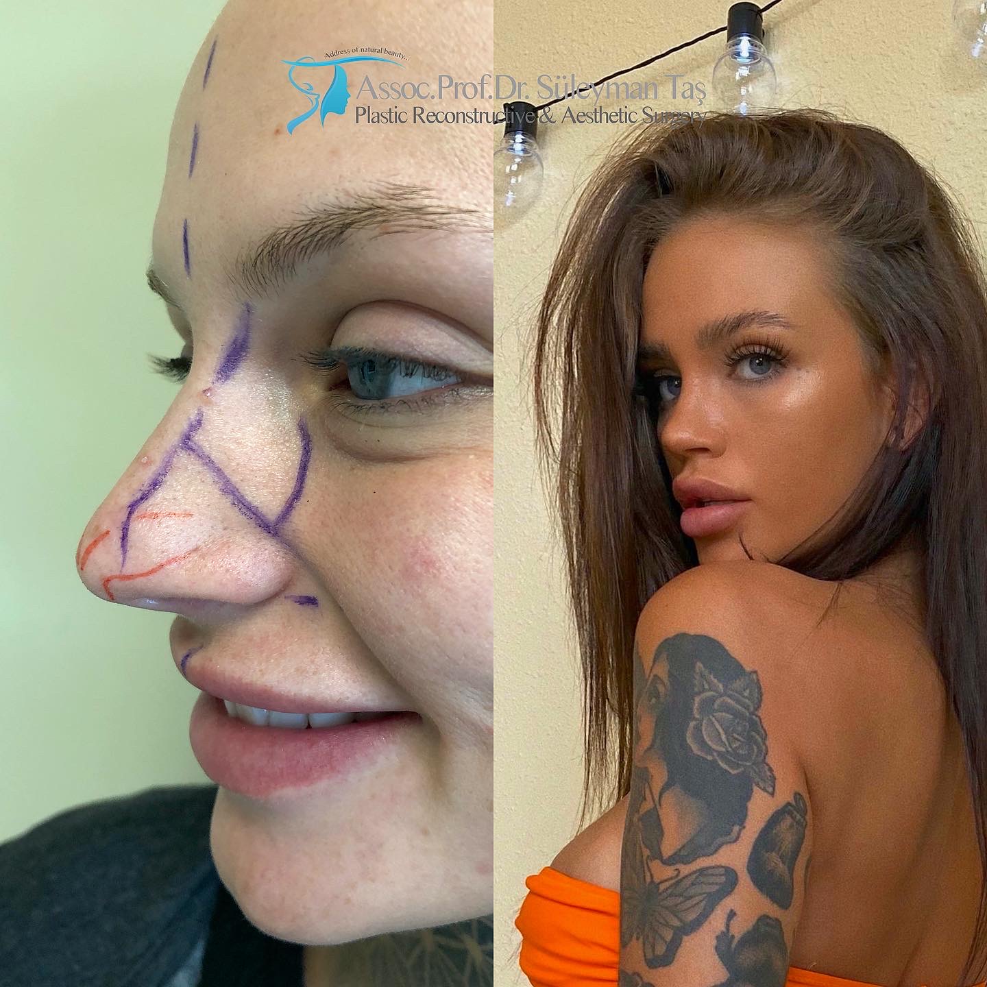 How much is the price of rhinoplasty?