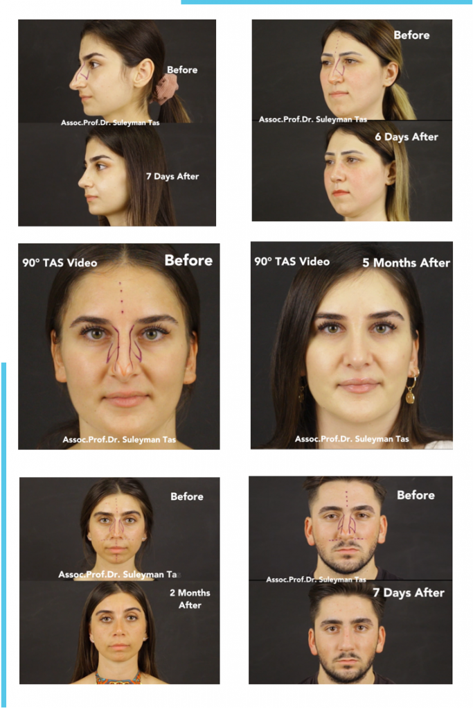 90° tas® video | rhinoplasty before and after videos
