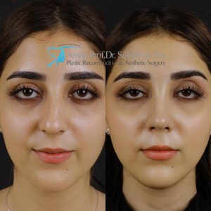 Best rhinoplasty before and after pictures