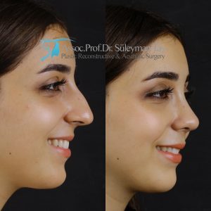 Best rhinoplasty before and after pictures