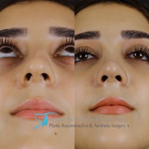 Is there scarring after a rhinoplasty (nose job)?