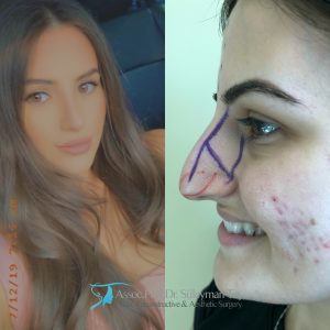 Celebrity nose job: before and after