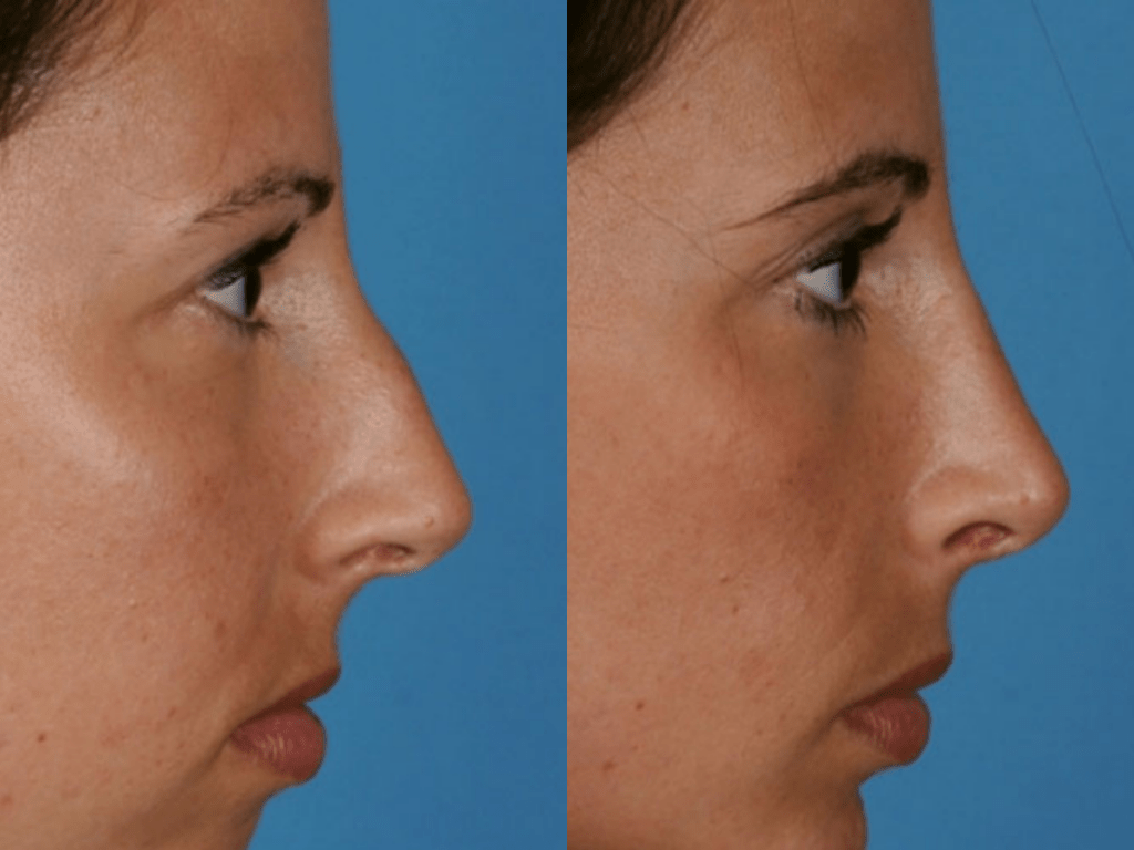 Aesthetic and functional rhinoplasty