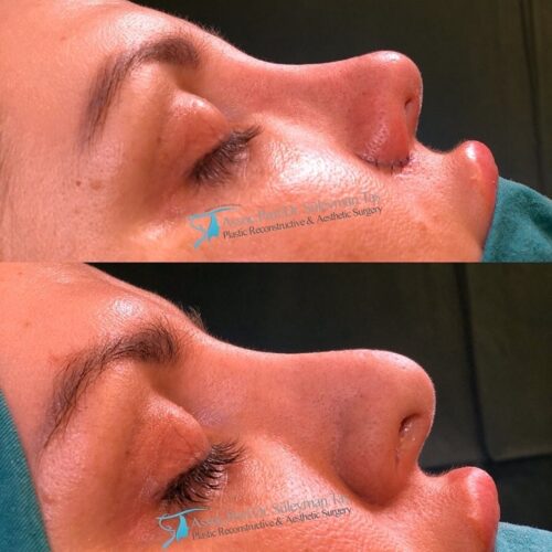 Revision nose job before and after 3