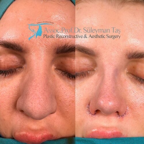 Revision nose job before and after 4
