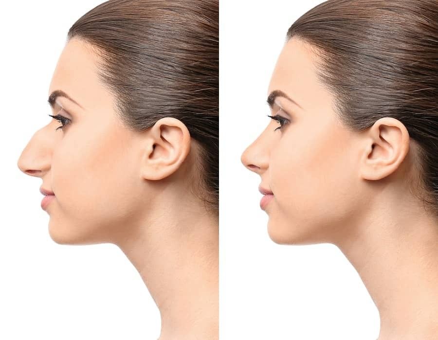 Aesthetic and functional rhinoplasty