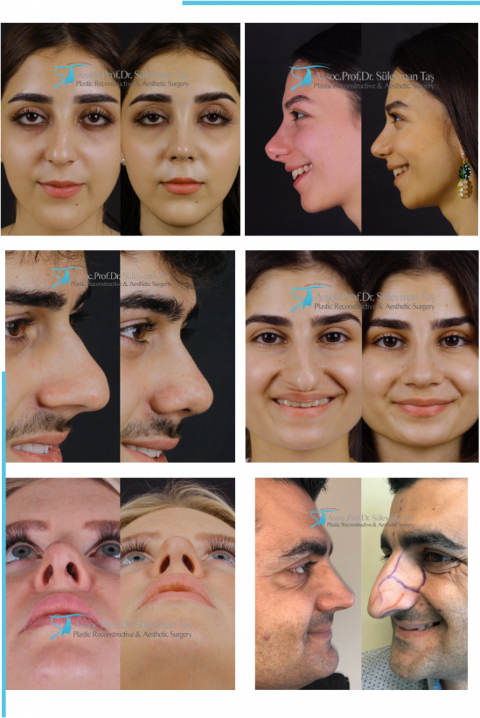 Best rhinoplasty before and after pictures