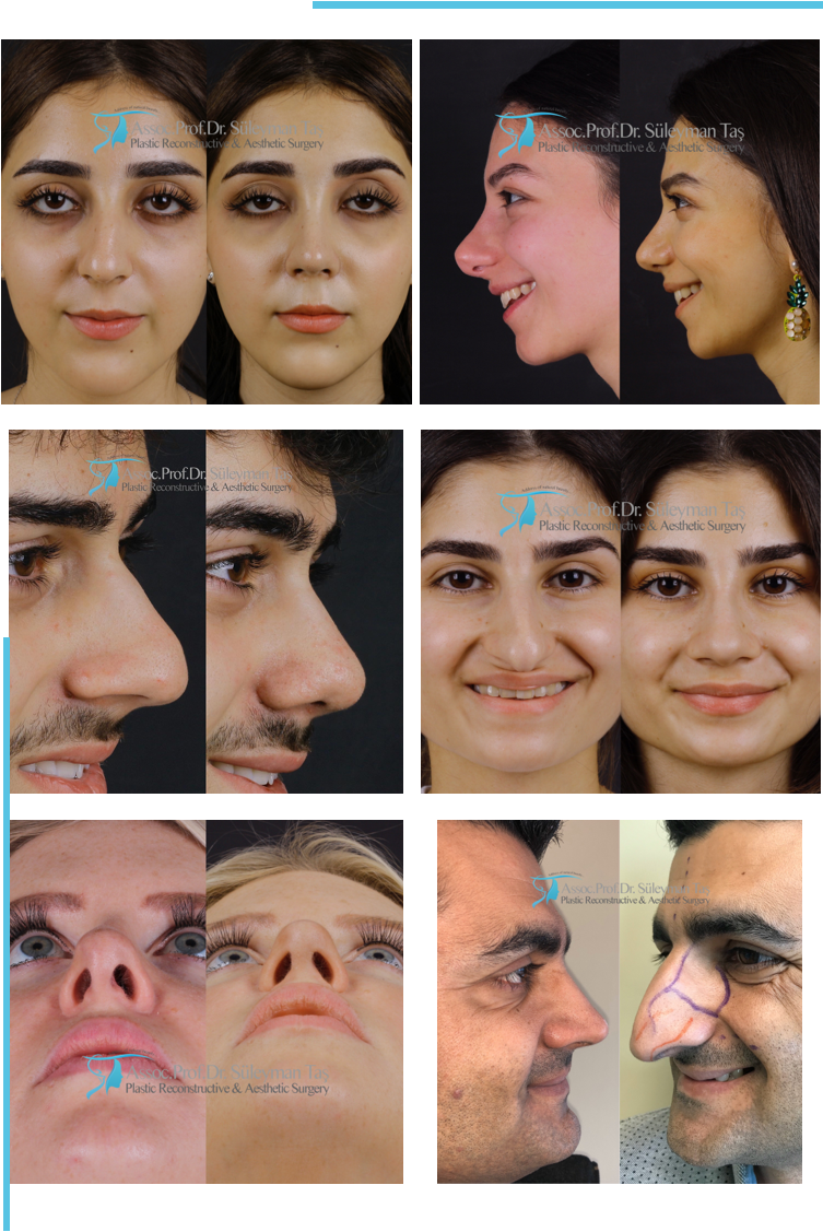 good rhinoplasty before and after