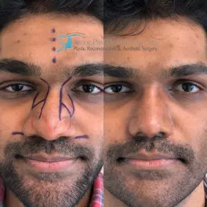 Ethnic rhinoplasty before and after