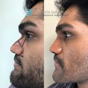 Ethnic rhinoplasty before and after