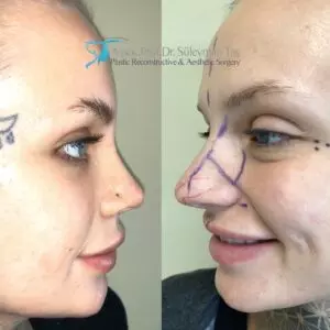 How long does it take to recover from a rhinoplasty?