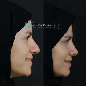 Nose job before and after