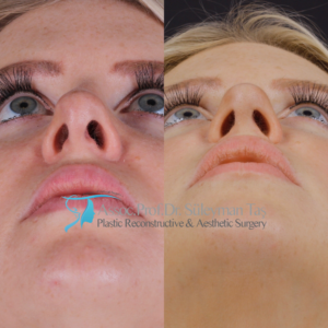Revision nose job before and after