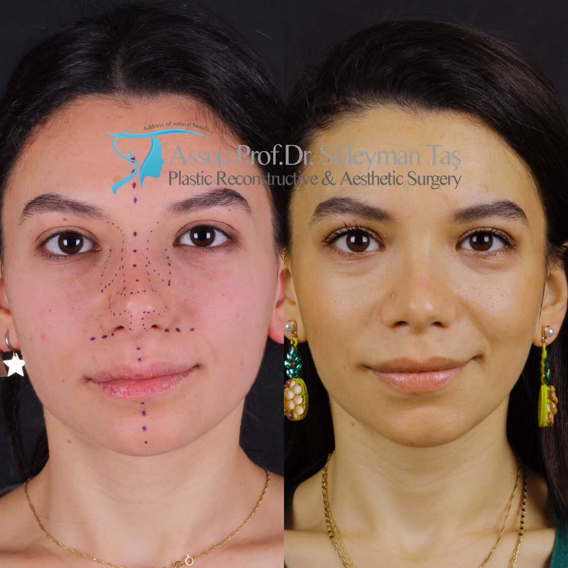 Revision rhinoplasty before and after