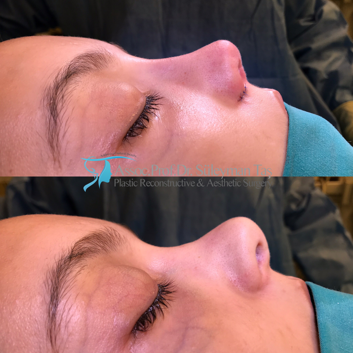 Revision rhinoplasty before and after 2