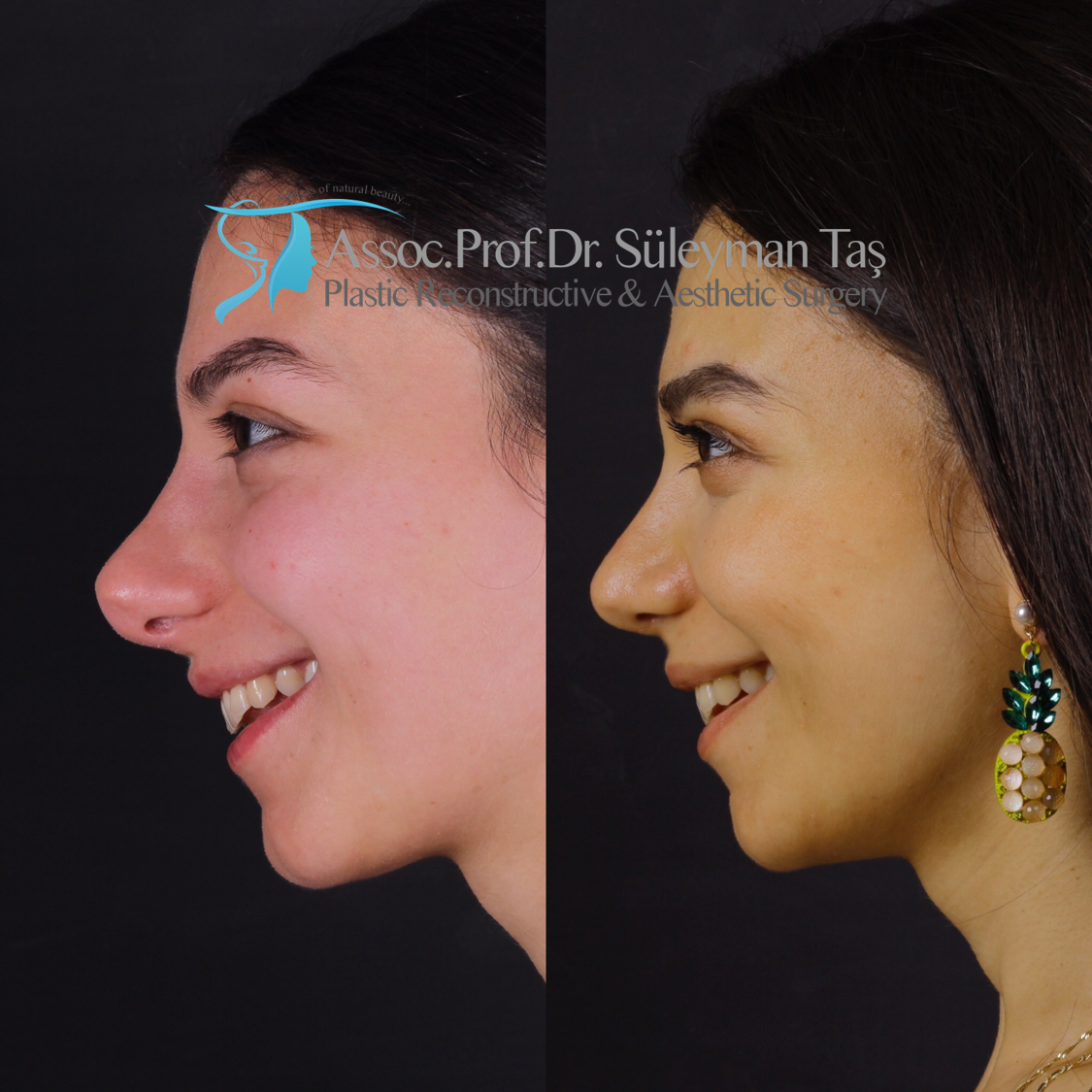 Revision rhinoplasty before and after