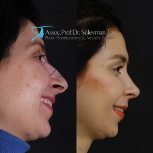 Rhinoplasty before and after hump treatment