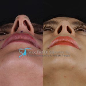 Rhinoplasty before and after hump treatment