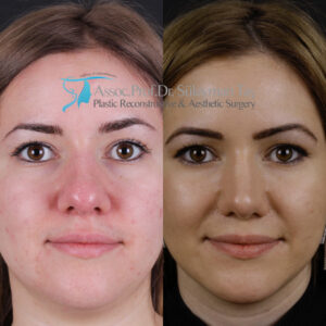 Rhinoplasty before and after thick skin
