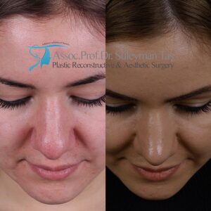 Rhinoplasty before and after thick skin