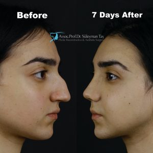 Causes and consequences of failed rhinoplasty