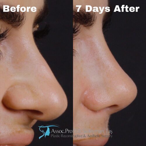 Bulbous nose tip 2