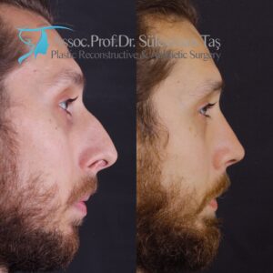 Profiloplasty: what is profile aesthetics?