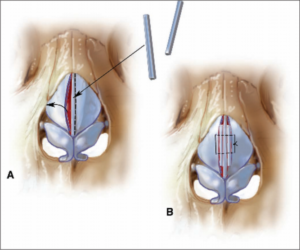 Nasal valve collapse