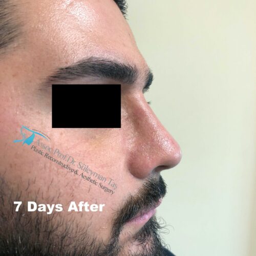 Thick skin male nose surgery