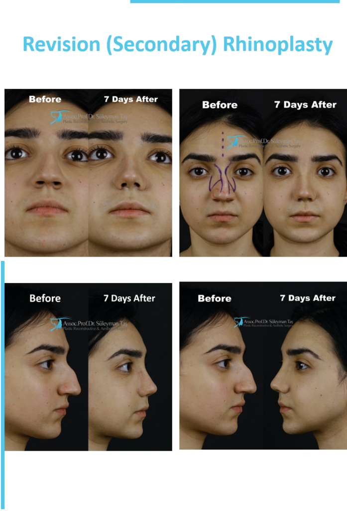 Causes and consequences of failed rhinoplasty