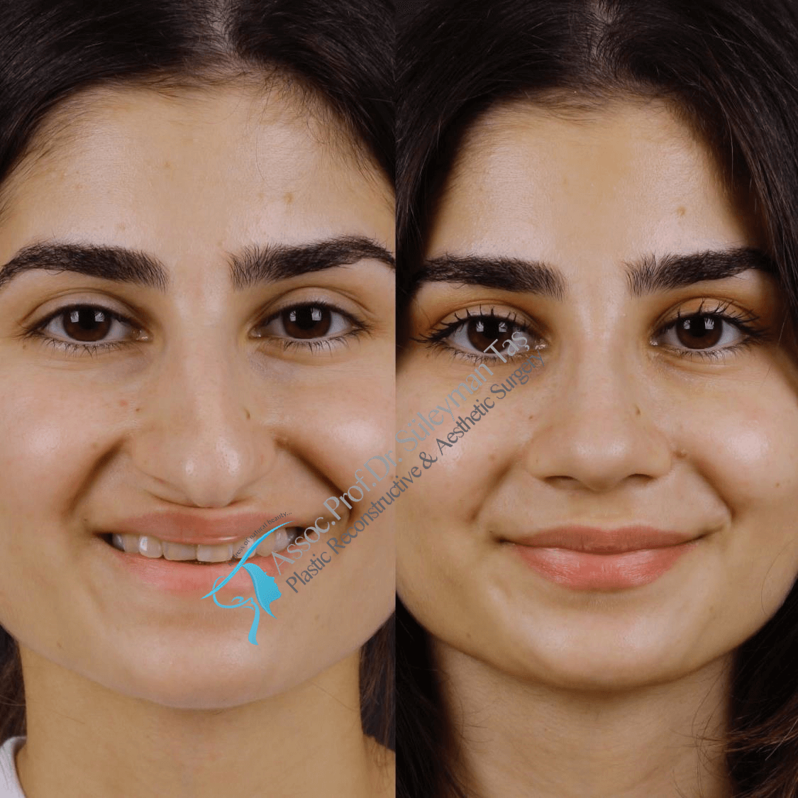 Before and after rhinoplasty female in istanbul